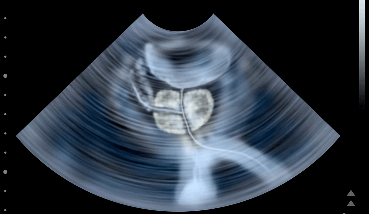 Kaļķakmens prostatīta ultraskaņas izmeklēšana
