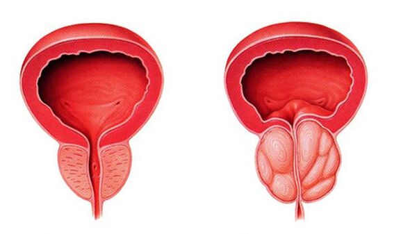 Normāla un iekaisusi prostata (prostatīts)