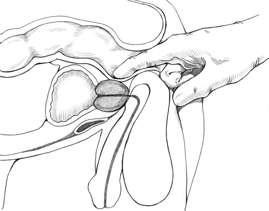 Prostatas masāža ir iekļauta prostatīta ārstēšanas metožu kompleksā